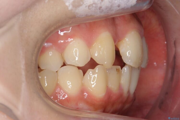 【20代女性】短期間で目立つ前歯の出っ歯とねじれをなおしたい 治療途中画像