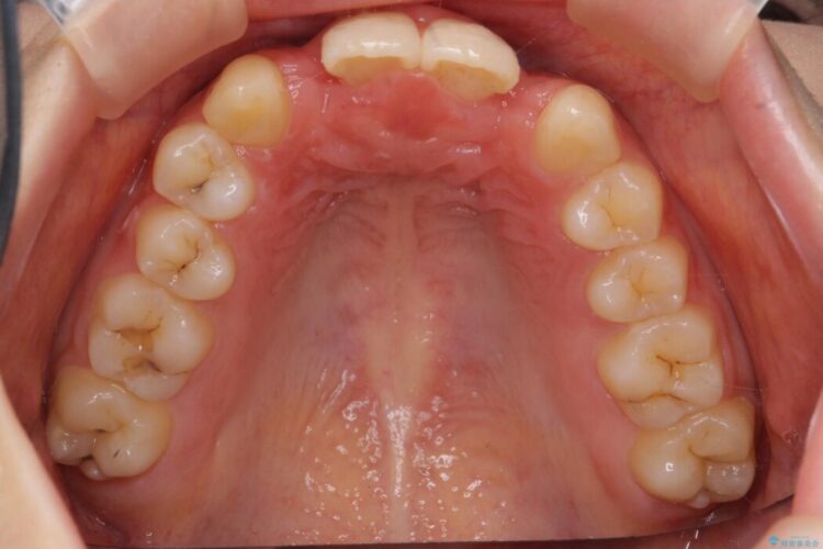 【20代女性】短期間で目立つ前歯の出っ歯とねじれをなおしたい 治療途中画像
