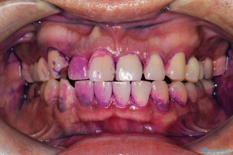 【30代男性】PMTCで歯をつるつるピカピカに 治療前画像