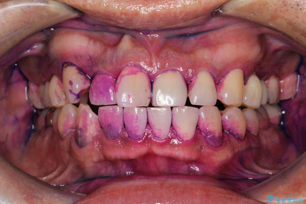 【30代男性】PMTCで歯をつるつるピカピカに 治療前