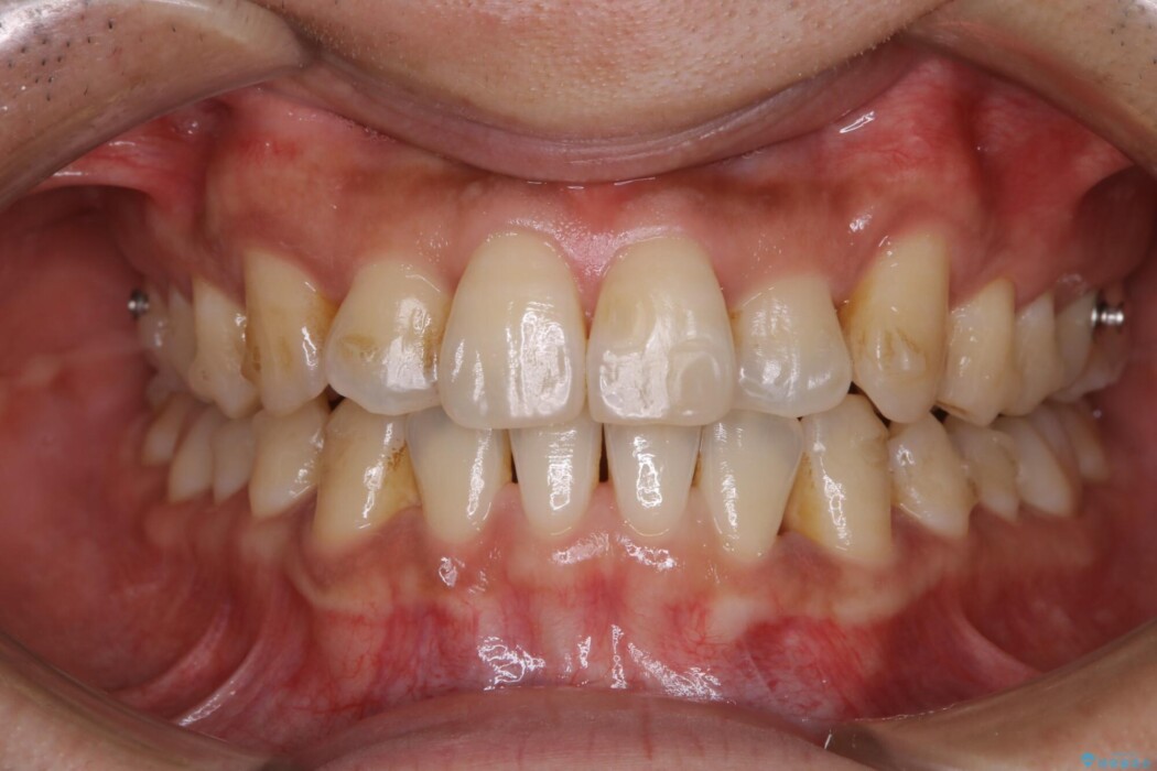 【20代男性】インビザラインの最中も白い歯でいたい 治療前