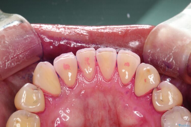 【30代男性】PMTCで歯をつるつるピカピカに 治療前画像