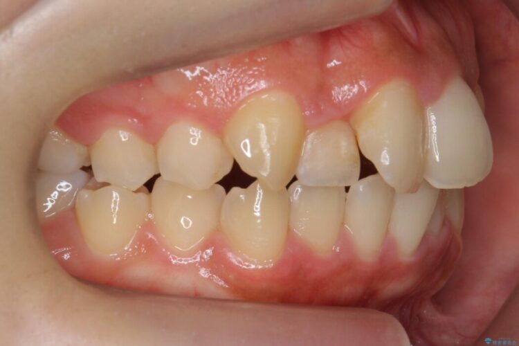 【20代女性】短期間で目立つ前歯の出っ歯とねじれをなおしたい 治療前画像
