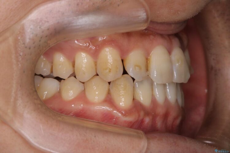 【20代男性】インビザラインの最中も白い歯でいたい 治療前画像