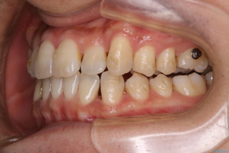 【20代男性】インビザラインの最中も白い歯でいたい 治療前画像