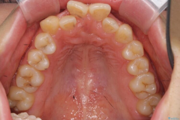 【20代女性】短期間で目立つ前歯の出っ歯とねじれをなおしたい 治療前画像