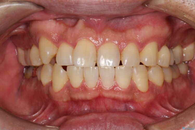 【30代男性】PMTCで歯をつるつるピカピカに 治療後画像