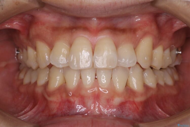 【20代男性】インビザラインの最中も白い歯でいたい 治療後画像