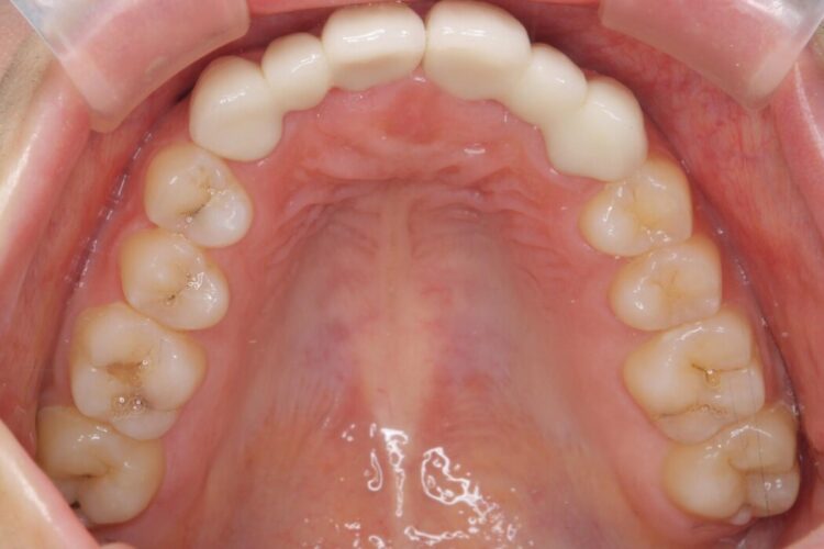 【20代女性】短期間で目立つ前歯の出っ歯とねじれをなおしたい 治療後画像