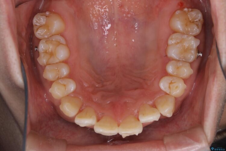 【20代男性】インビザラインの最中も白い歯でいたい 治療後画像