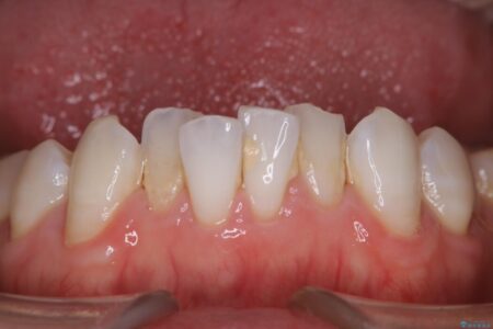 【30代男性】こびり付いた歯石をPMTCで取り除く 治療前