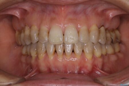 【40代女性】茶色い歯の汚れを落としてつるつるに 治療前