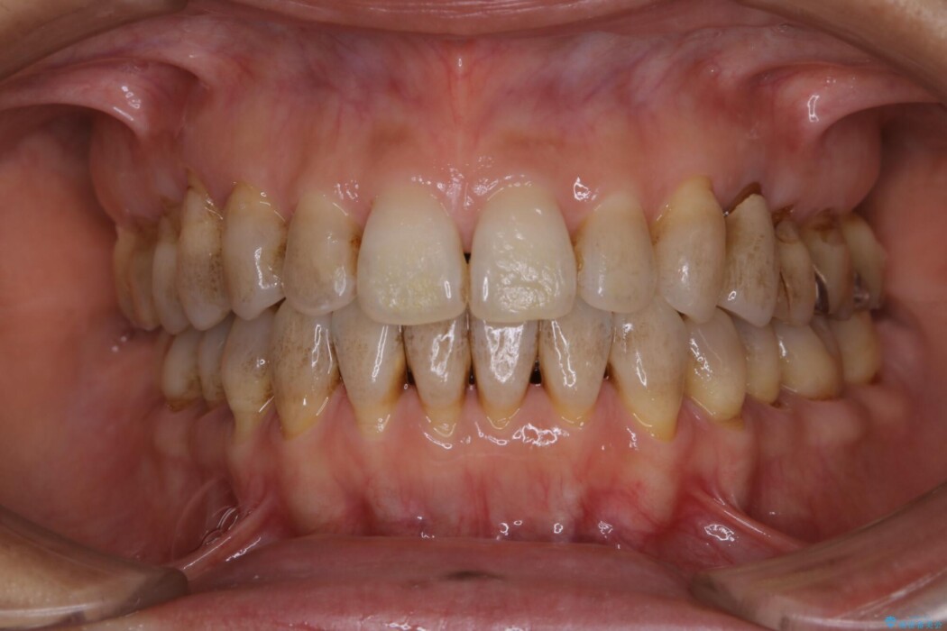 【40代女性】茶色い歯の汚れを落としてつるつるに 治療前