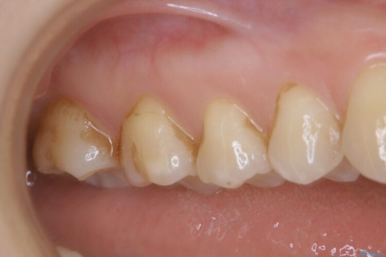 【30代女性】奥歯のざらつきを除去する 治療前画像
