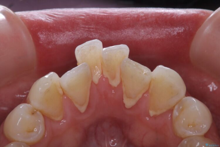 【30代男性】こびり付いた歯石をPMTCで取り除く 治療前画像
