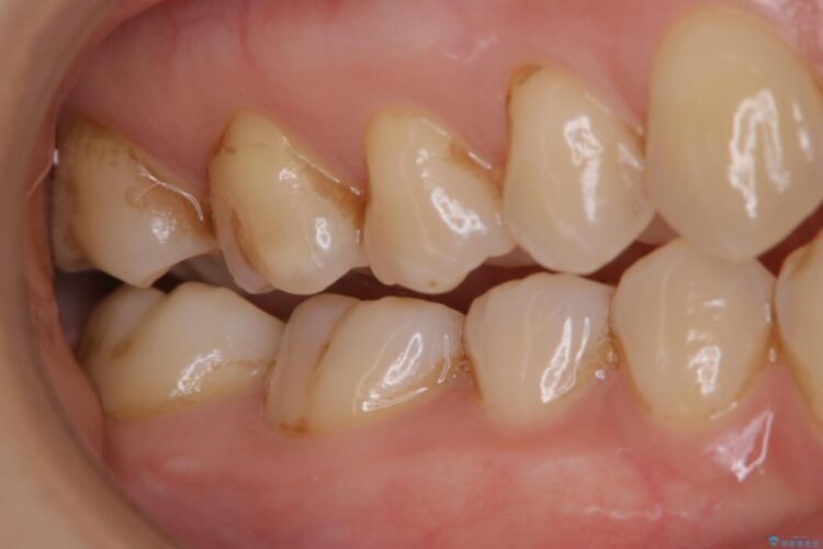 【30代女性】奥歯のざらつきを除去する 治療前画像