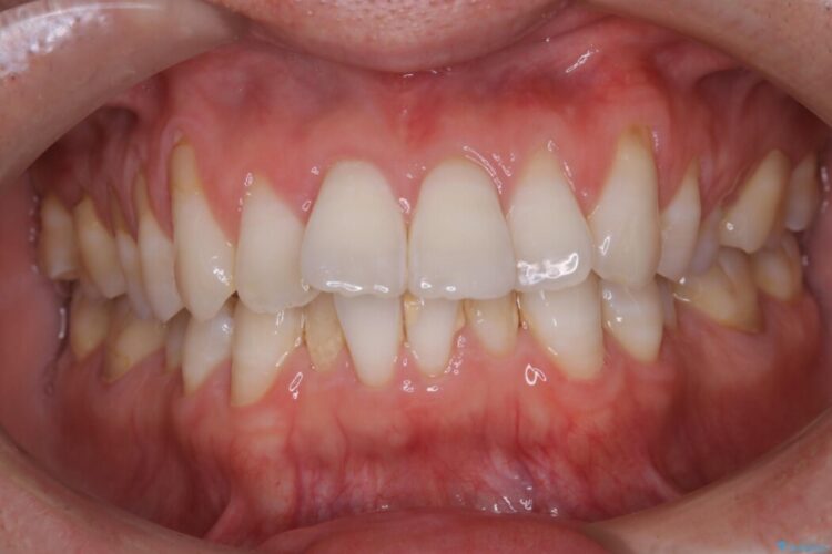 【30代男性】こびり付いた歯石をPMTCで取り除く 治療前画像