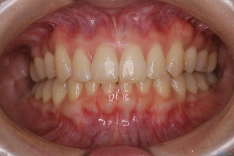 【20代女性】医療ホワイトニング１日で白い歯に 治療前画像
