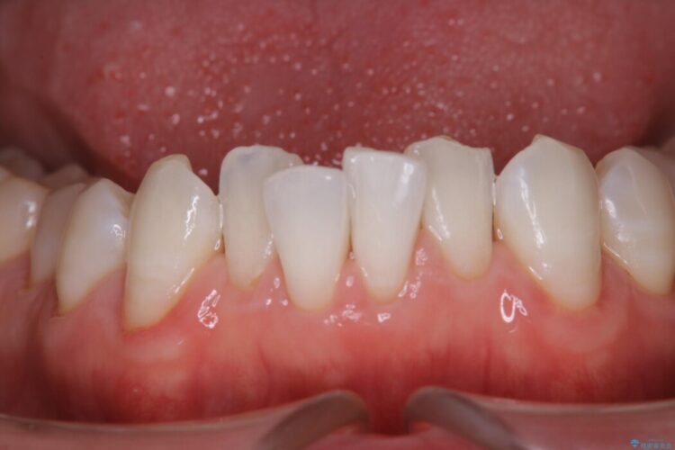 【30代男性】こびり付いた歯石をPMTCで取り除く 治療後画像