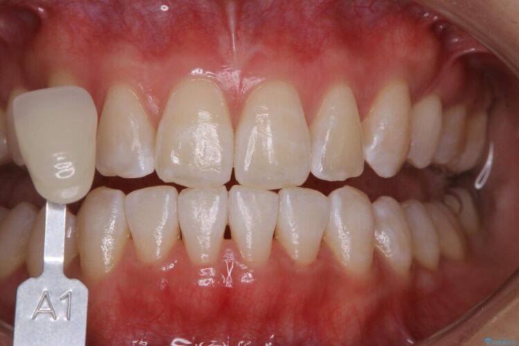 【20代女性】医療ホワイトニング１日で白い歯に 治療後画像