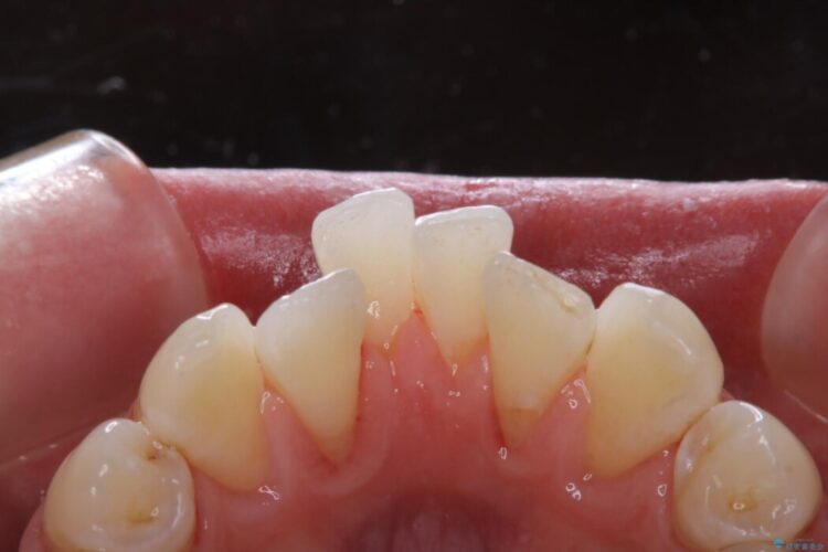 【30代男性】こびり付いた歯石をPMTCで取り除く 治療後画像