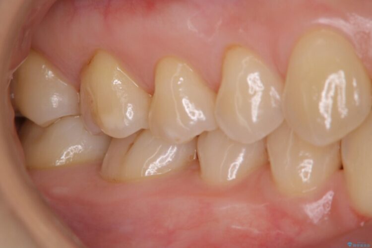 【30代女性】奥歯のざらつきを除去する 治療後画像