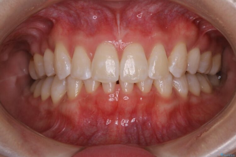 【20代女性】医療ホワイトニング１日で白い歯に 治療後画像