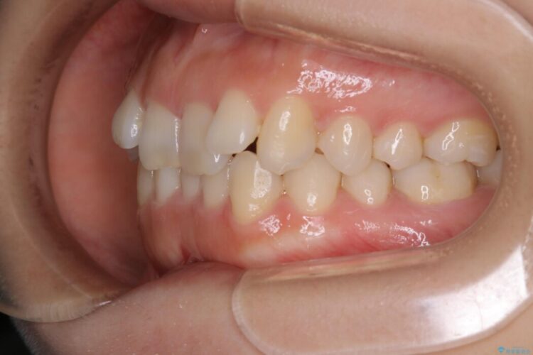 【20代女性】短期間で行う歯列のガタつき改善 治療前画像