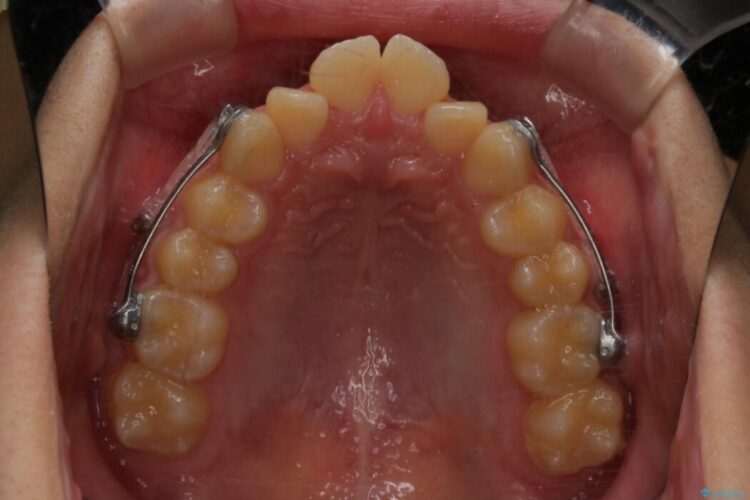 【10代男性】出っ歯(上顎前突)を劇的に改善するインビザラインとカリエールの併用治療 治療途中画像