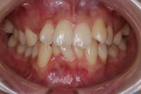 【20代女性】埋伏する犬歯を抜歯し、強いガチャ歯（叢生）をワイヤー矯正治療 治療前