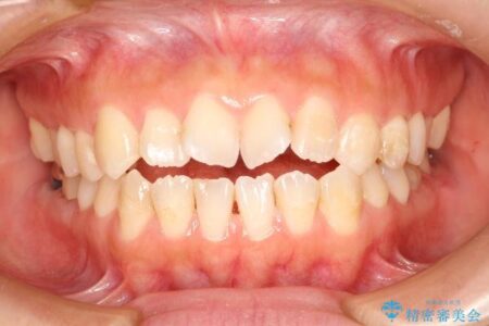【20代女性】前歯が噛み合わないオープンバイト（開咬）をインビザライン矯正治療 治療前