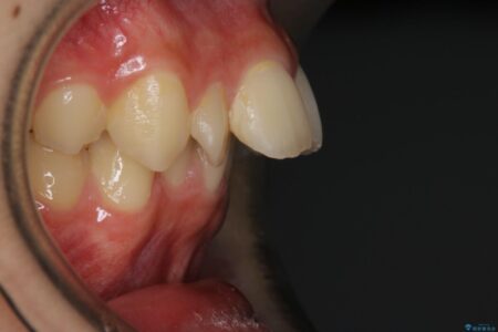 【10代男性】出っ歯(上顎前突)を劇的に改善するインビザラインとカリエールの併用治療 治療前
