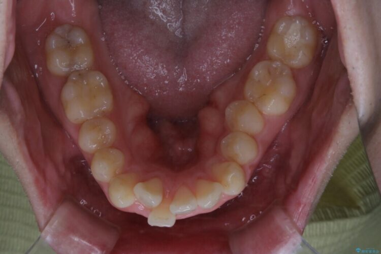 【20代男性】口ゴボ(出っ歯)と正中のズレをワイヤー矯正治療 治療前画像