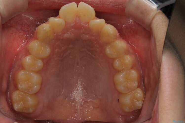 【10代男性】出っ歯(上顎前突)を劇的に改善するインビザラインとカリエールの併用治療 治療前画像