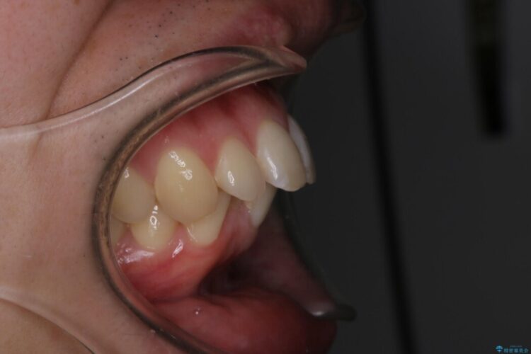 【20代男性】口ゴボ(出っ歯)と正中のズレをワイヤー矯正治療 治療前画像