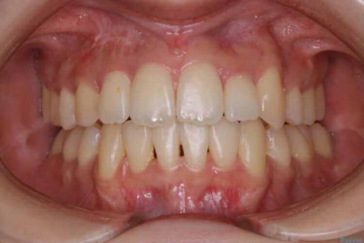 【20代女性】埋伏する犬歯を抜歯し、強いガチャ歯（叢生）をワイヤー矯正治療 アフター