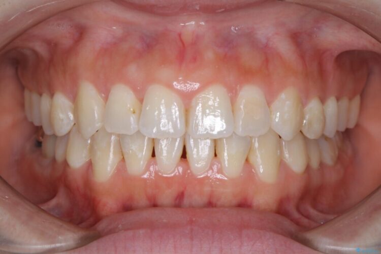 【20代女性】前歯が噛み合わないオープンバイト（開咬）をインビザライン矯正治療 アフター
