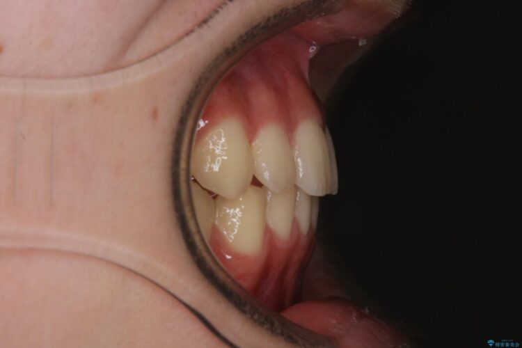 【10代男性】出っ歯(上顎前突)を劇的に改善するインビザラインとカリエールの併用治療 アフター