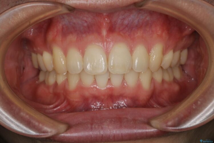 【20代男性】口ゴボ(出っ歯)と正中のズレをワイヤー矯正治療 治療後画像