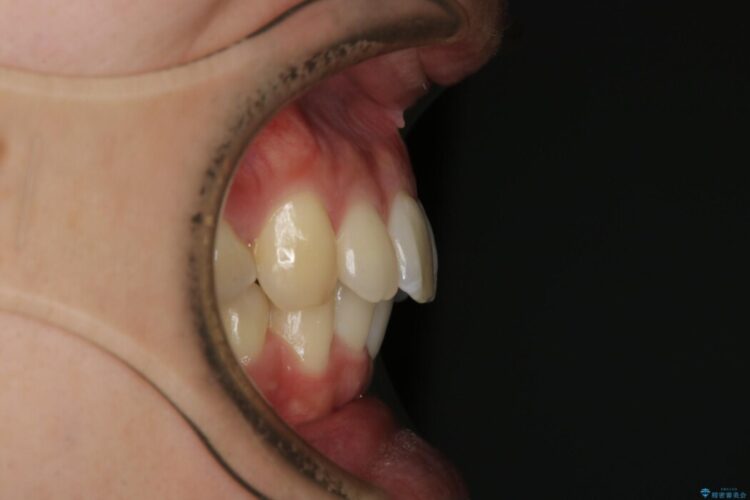 【20代男性】口ゴボ(出っ歯)と正中のズレをワイヤー矯正治療 治療後画像