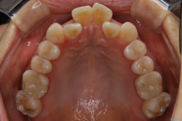 【40代女性】奥に引っ込んでいる前歯と反対咬合をインビザラインで矯正治療 治療前画像