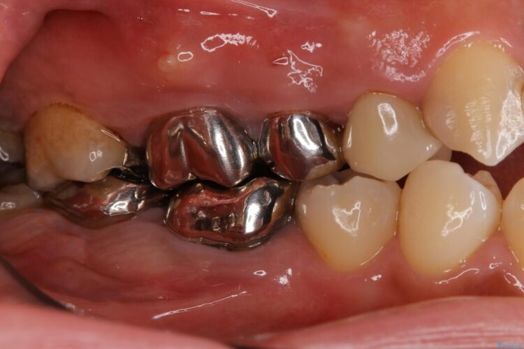 【40代女性】奥歯の違和感をインプラント治療で解決 ビフォー