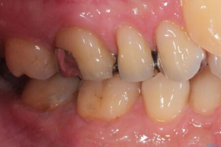 【40代男性】銀歯をセラミックにやり替え 治療前