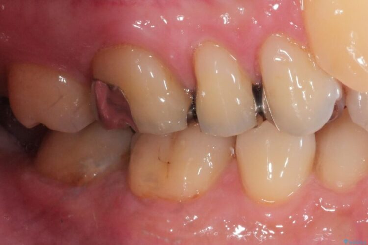 【40代男性】銀歯をセラミックにやり替え 治療前画像