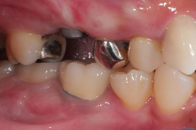 【40代女性】奥歯の違和感をインプラント治療で解決 治療途中画像