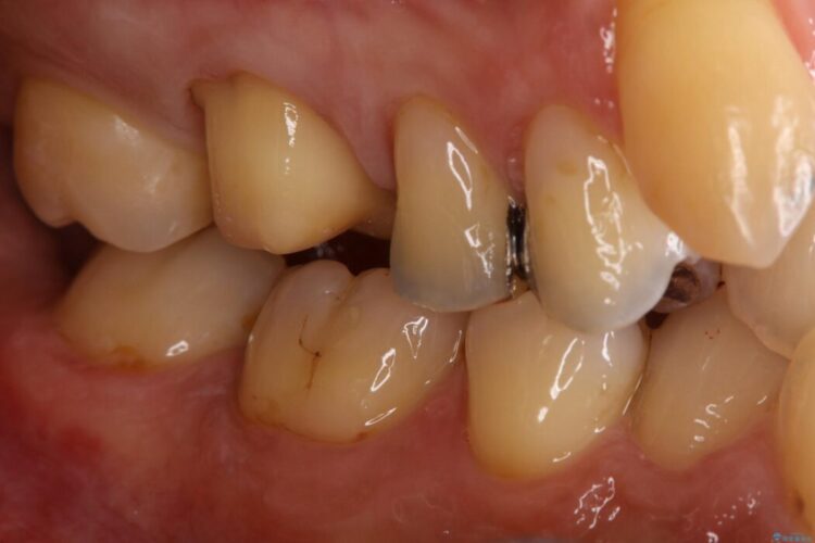 【40代男性】銀歯をセラミックにやり替え 治療途中画像