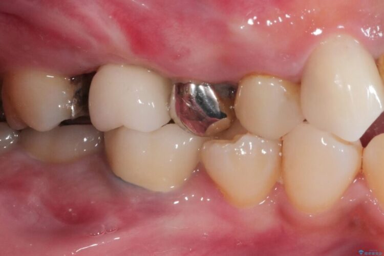 【40代女性】奥歯の違和感をインプラント治療で解決 アフター