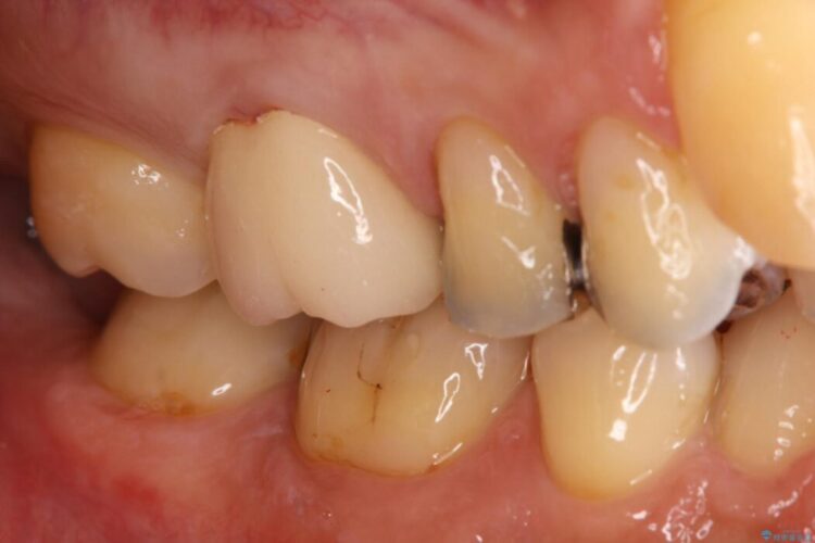 【40代男性】銀歯をセラミックにやり替え 治療後画像