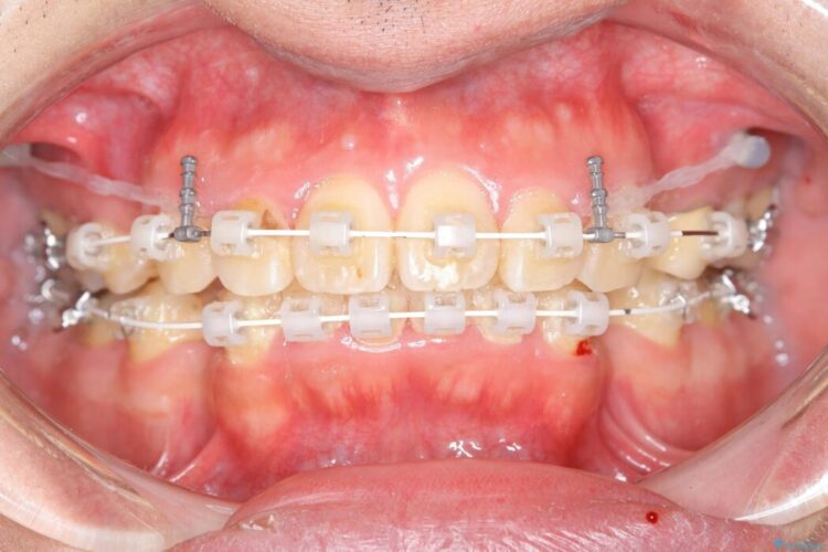 【30代男性】ワイヤー矯正で出っ歯とガタつきの改善 治療途中画像