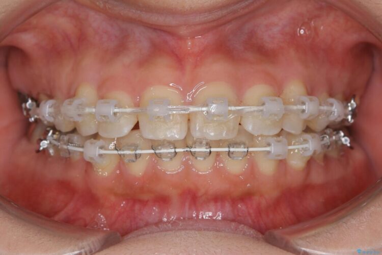 【20代女性】矯正治療後の後戻り 治療途中画像